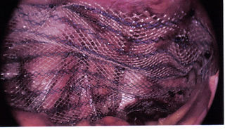 case 3 after mesh placement.jpg